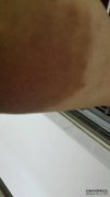 [？女人左腋下的针灸疼痛是什么？]