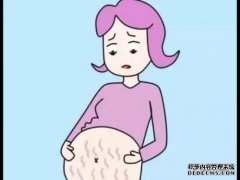 孕妇该如何预防妊娠纹