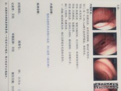 HP胃镜检查是什么意思？