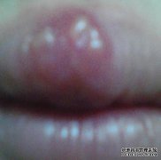 你好，你的嘴唇突然肿胀，这是非常困难的。你