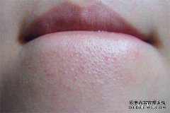 如果我姨妈很久以前患有粉刺，该怎么办？