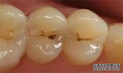 如何区分孔，凹槽和色素沉着