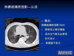CT可以检查肺部疾病
